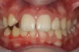 Before treatment: Short term orthodontics completed in 7 months with tooth whitening