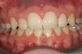 After treatment: Short term orthodontics completed in 7 months with tooth whitening