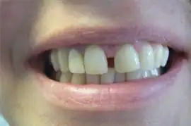 Before treatment: NHS Orthodontics