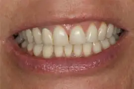 After treatment: NHS Orthodontics