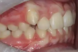 Before treatment: NHS Orthodontic Treatment