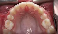 After treatment: Natural looking crown and bridge work