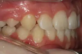 After treatment: NHS Orthodontic Treatment