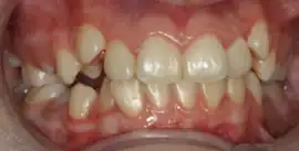 Before treatment: Private Adult Braces