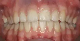 After treatment: Private Adult Braces