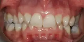 Before treatment: Comprehensive Fixed Orthodontic treatment