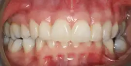 After treatment: Comprehensive Fixed Orthodontic treatment