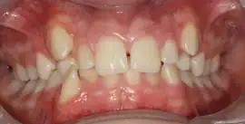 Before treatment: Simple tooth Whitening with Natural Cosmetic restorations