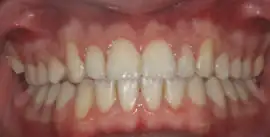 After treatment: Simple tooth Whitening with Natural Cosmetic restorations