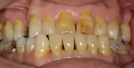 Before treatment: Implant placed in Upper Arch