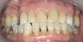 After treatment: Implant placed in Upper Arch