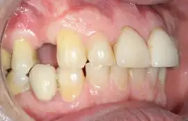 Before treatment: NHS Orthodontics