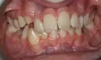 Before treatment: Six month smiles: Short term orthodontics with tooth whitening