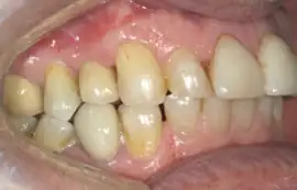 After treatment: NHS Orthodontics