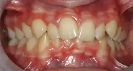 Before treatment: Fixed Orthodontic Appliances For adults
