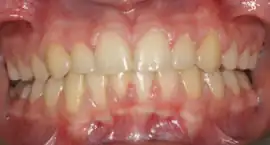 After treatment: Fixed Orthodontic Appliances For adults