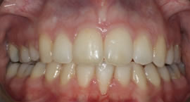 How Can Composite Bonding Help With Teeth Whitening?
