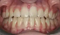 After treatment: Six month smiles: Short term orthodontics with tooth whitening