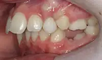 Before treatment: Six month smiles: Short term orthodontics with tooth whitening