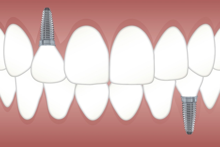 Despite Difficult Economic Conditions, Tooth Implants Remain Popular