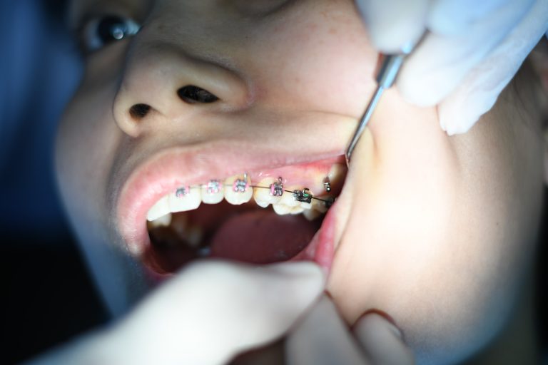What happens if you are not happy with your teeth after braces