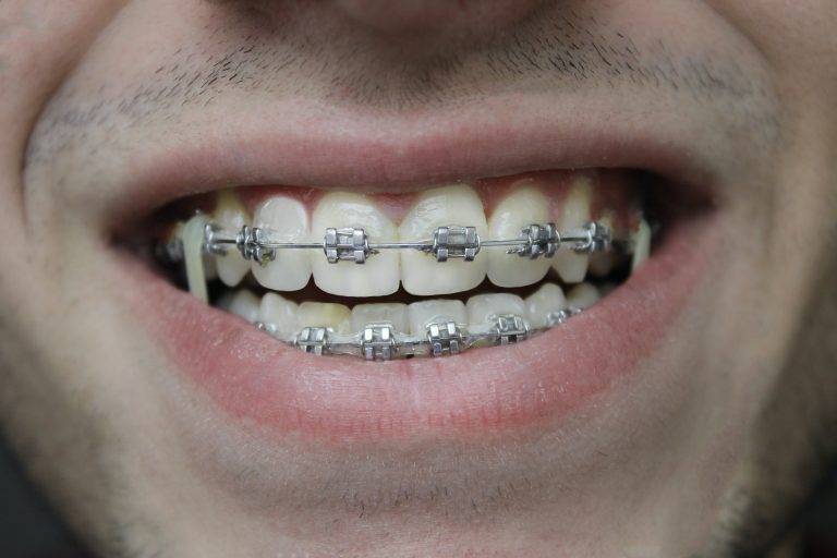 Questions to ask an orthodontist before getting braces