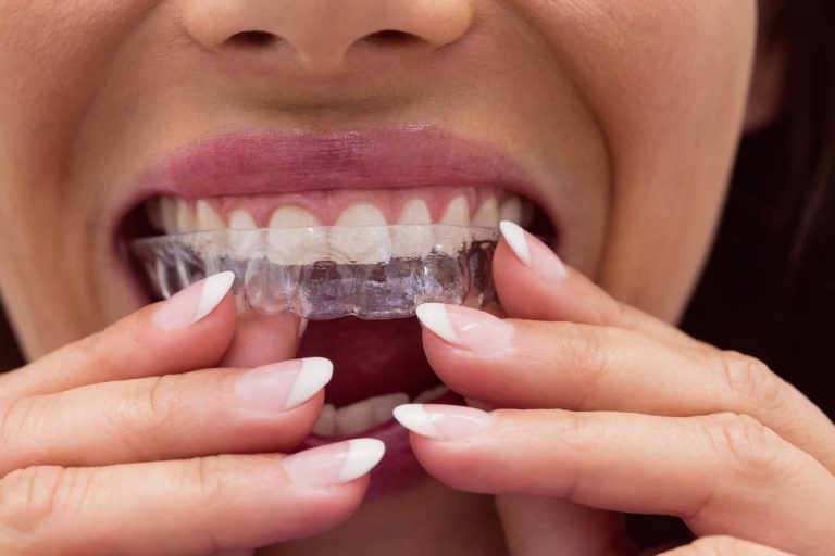 What Drinks Should I Avoid While Wearing Invisalign Braces?