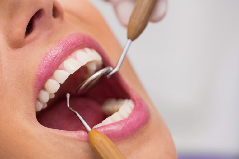 How long does bonding last on your teeth?