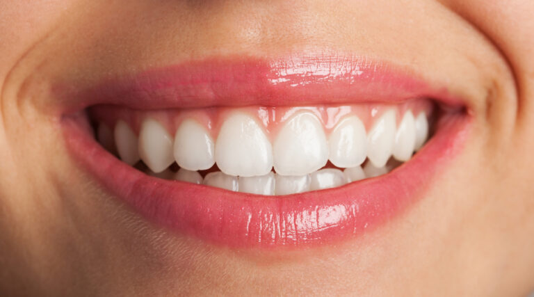 Do bonded teeth turn yellow?