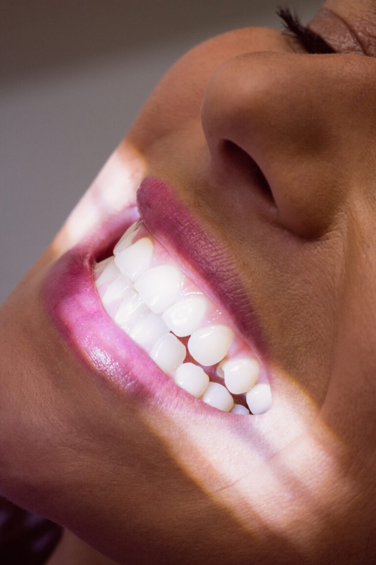 Can you whiten a dental crown?